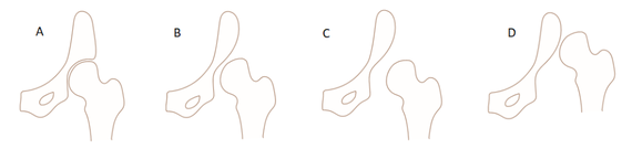 Kom en kop van de heup horen in elkaar te passen zoals op plaatje A. Op plaatje B, C en D zijn steeds ernstigere vormen van heupdysplasie te zien.